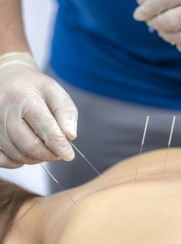Acupuncture treatment